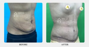 Tummy Tuck Surgery result - Med Esthetiks -01