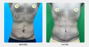 Tummy Tuck Surgery result - Med Esthetiks