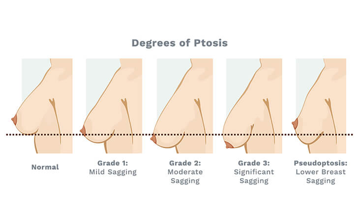 breast lift surgery