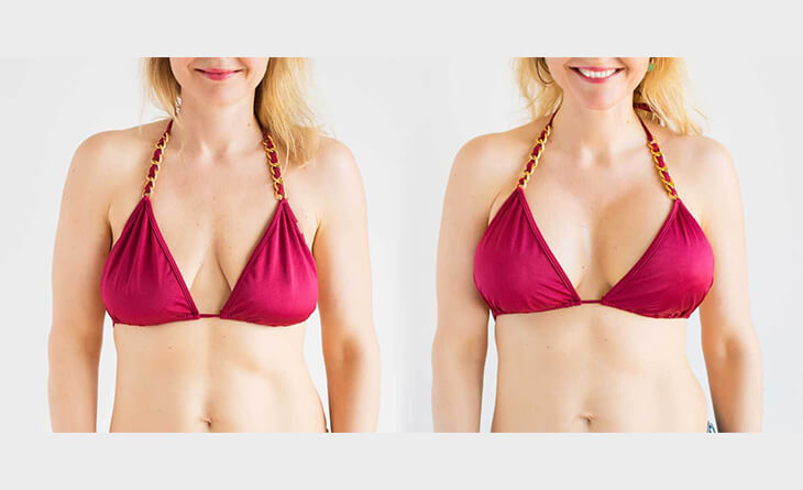 Breast Lift Surgery