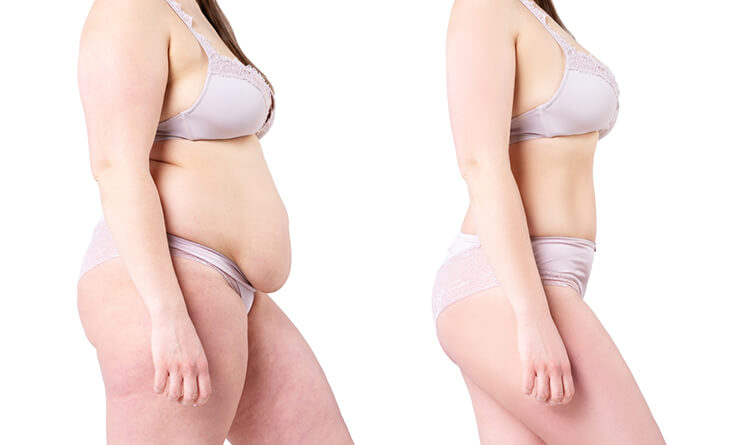 liposuction surgery