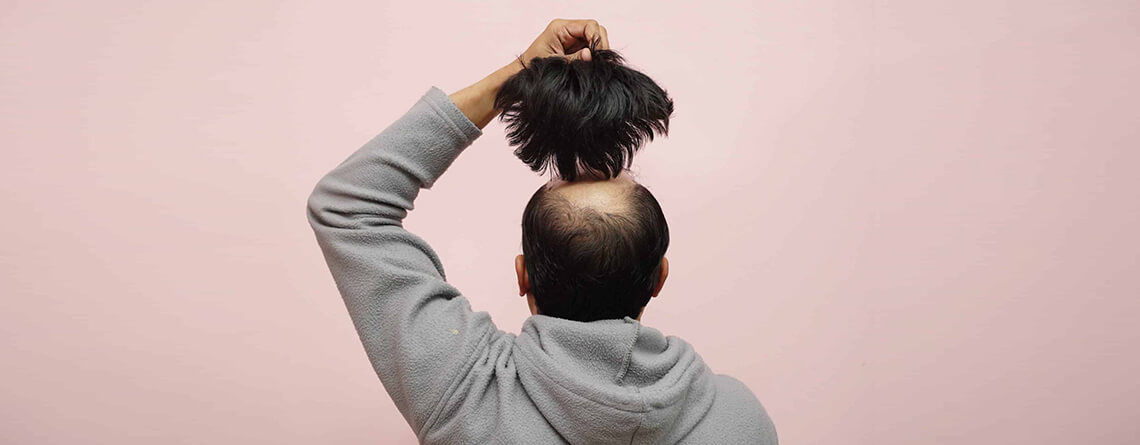 Hair Transplant Treatment