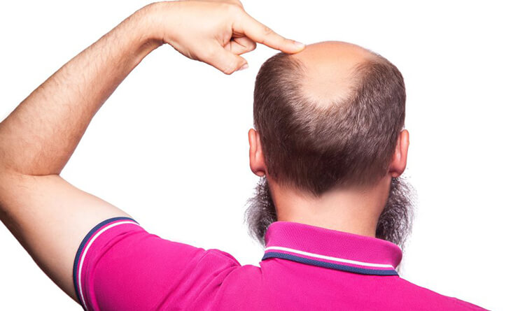 Hair Transplant Treatment
