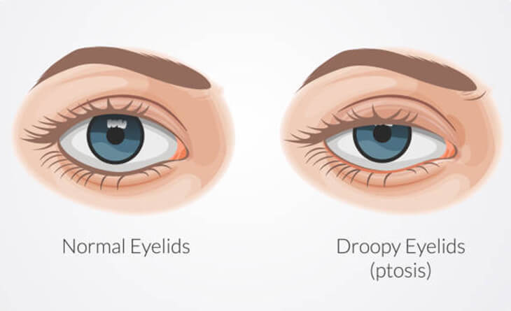 eyelid surgery