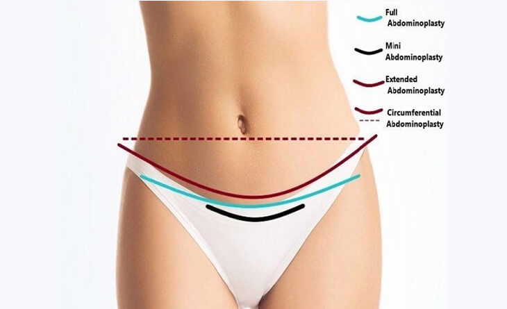 tummy tuck surgery