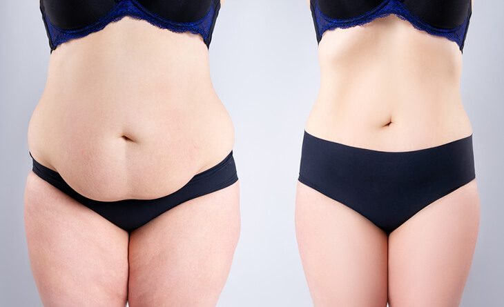 tummy tuck surgery
