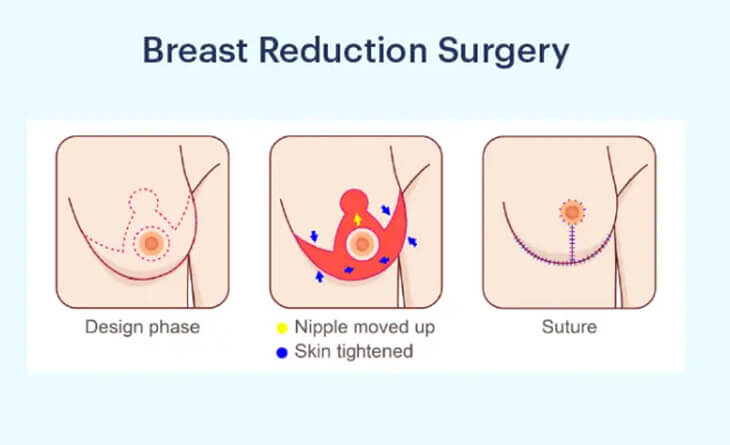 breast reduction surgery