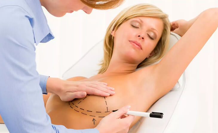 breast augmentation procedure