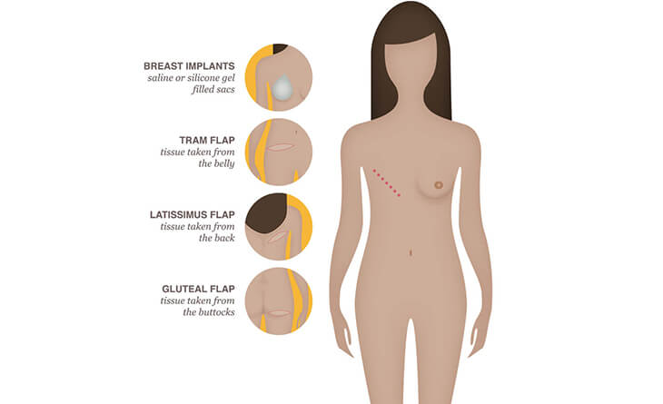breast augmentation procedure