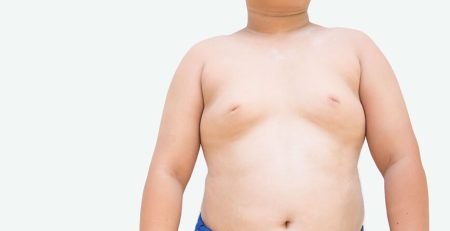 gynecomastia surgery