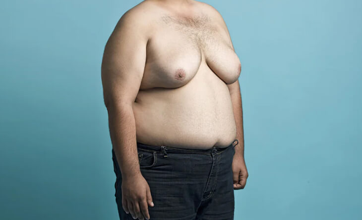 gynecomastia surgery