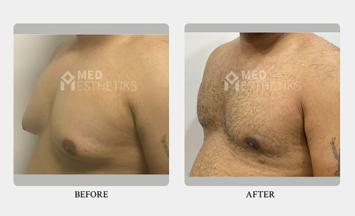 gynecomastia surgery before and after