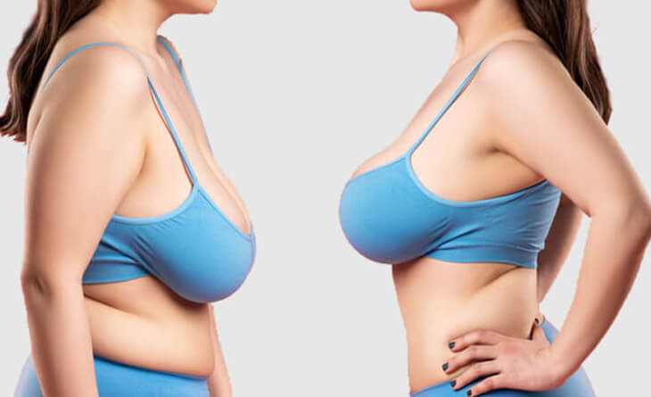 breast reduction surgery