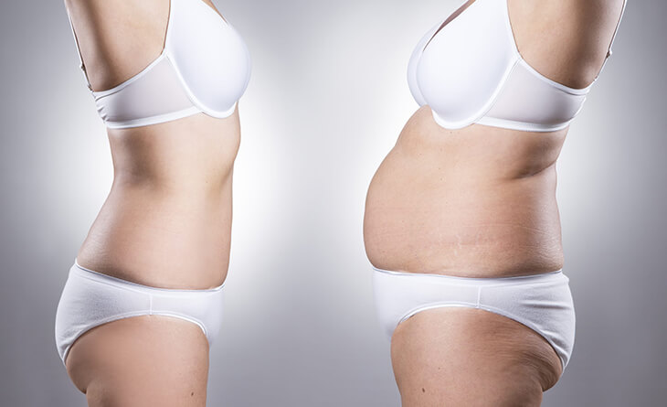 tummy tuck surgery