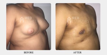 gynecomastia surgery before and after
