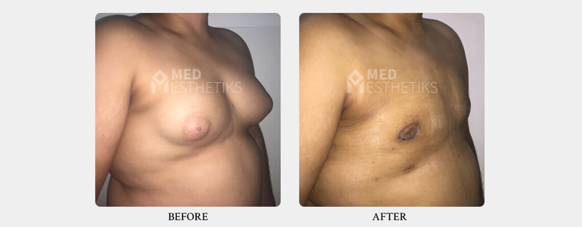 gynecomastia surgery before and after
