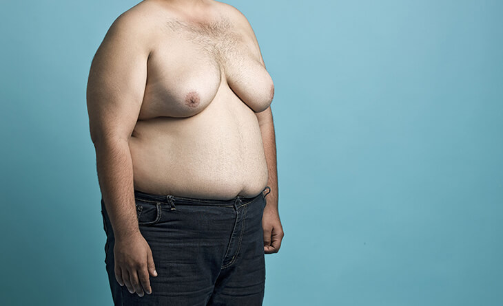 gynecomastia surgery