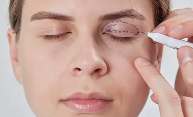 eyelid surgery