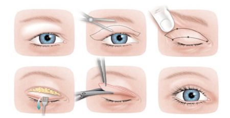 eyelid surgery