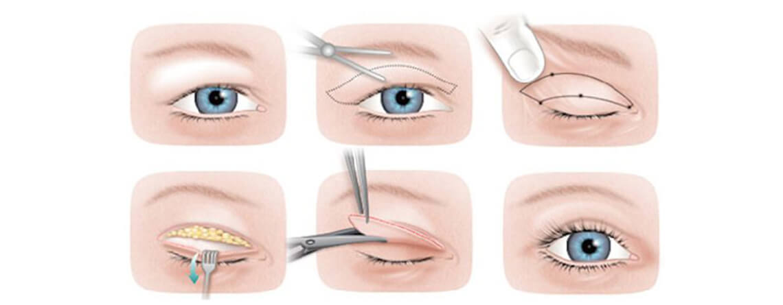 eyelid surgery