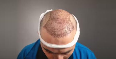 hair transplant surgery in delhi