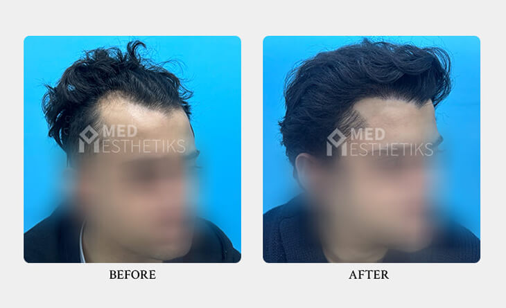 hair transplant surgery before and after
