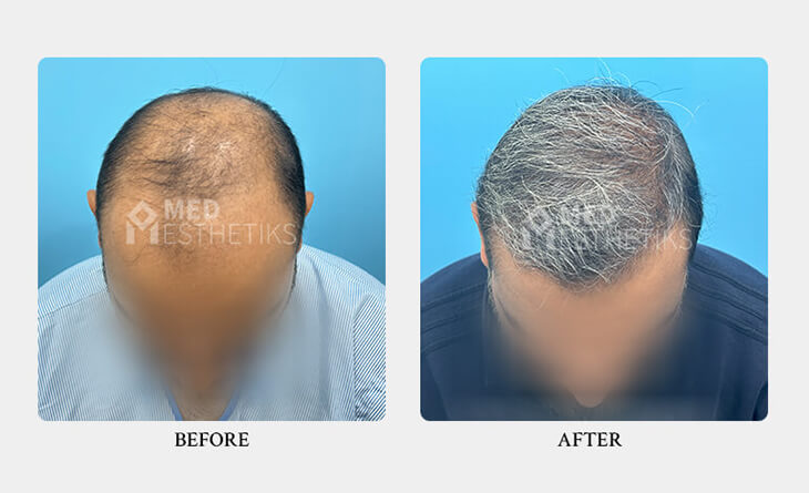 hair transplant surgery before and after