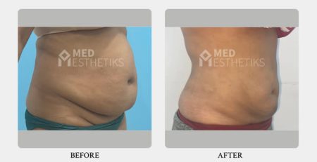 liposuction surgery before and after