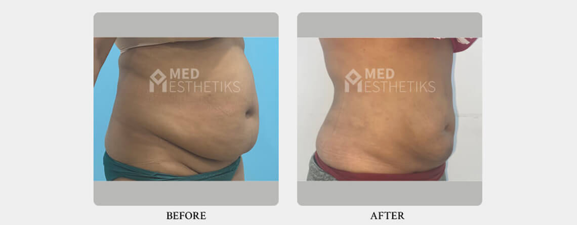 liposuction surgery before and after