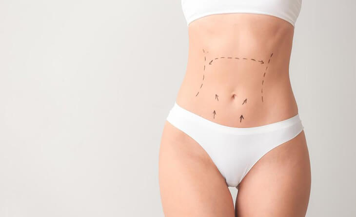 liposuction surgery