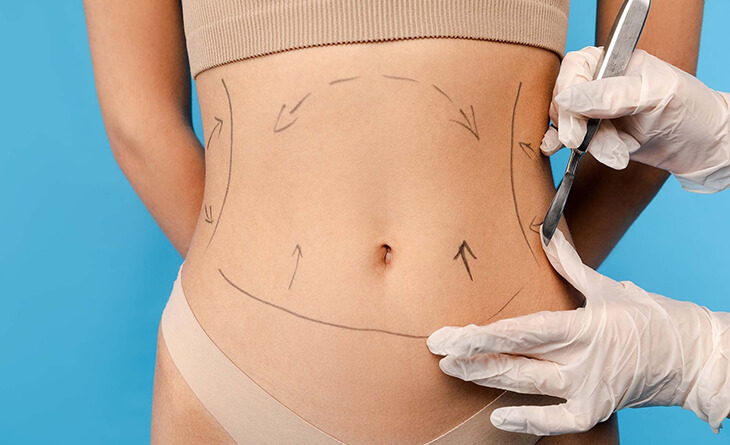 liposuction surgery