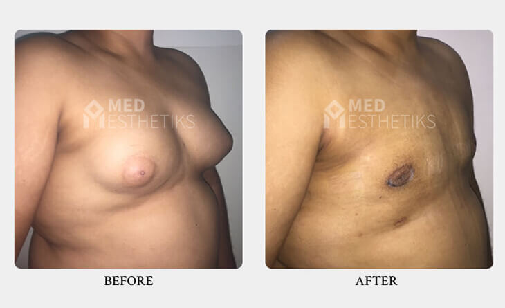 gynecomastia surgery