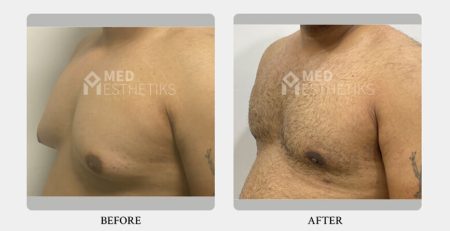 gynecomastia surgery before and after