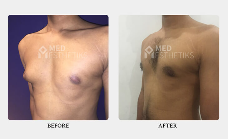 gynecomastia surgery before and after