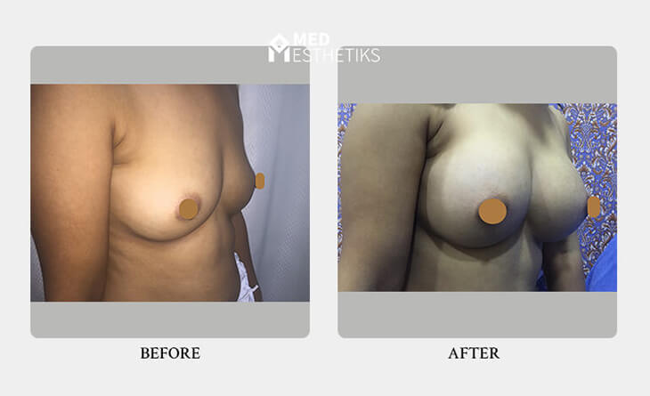 breast augmentation surgery