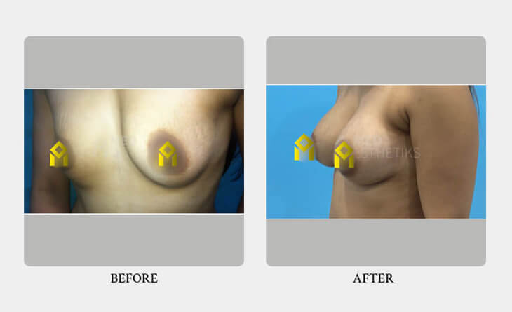 breast augmentation surgery before and after