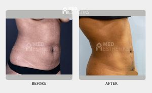 liposuction surgery before and after