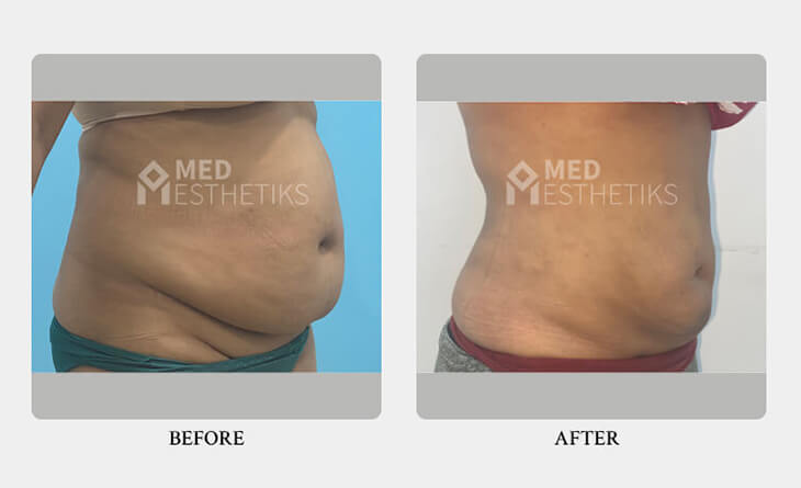 liposuction surgery before and after
