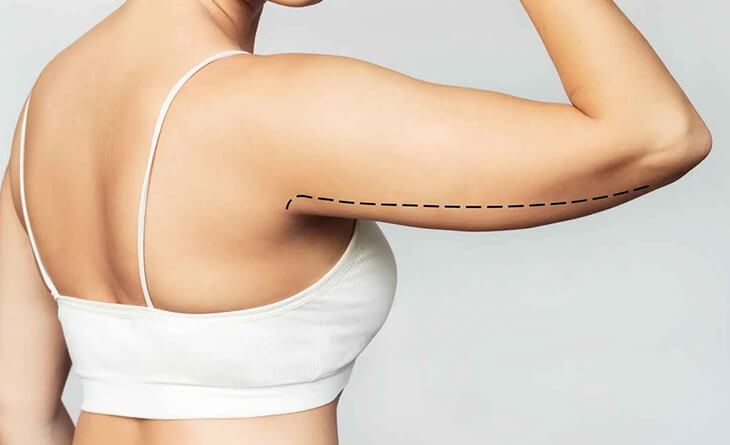 Arm liposuction surgery