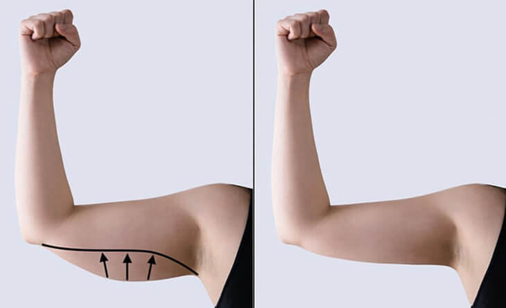 Arm liposuction surgery