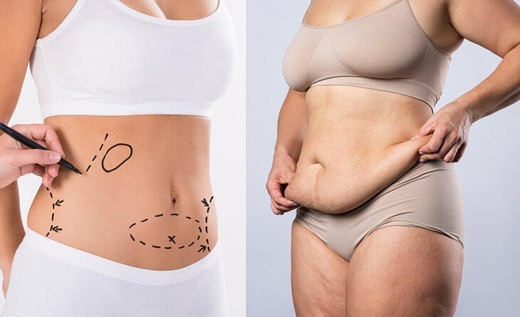 tummy tuck surgery