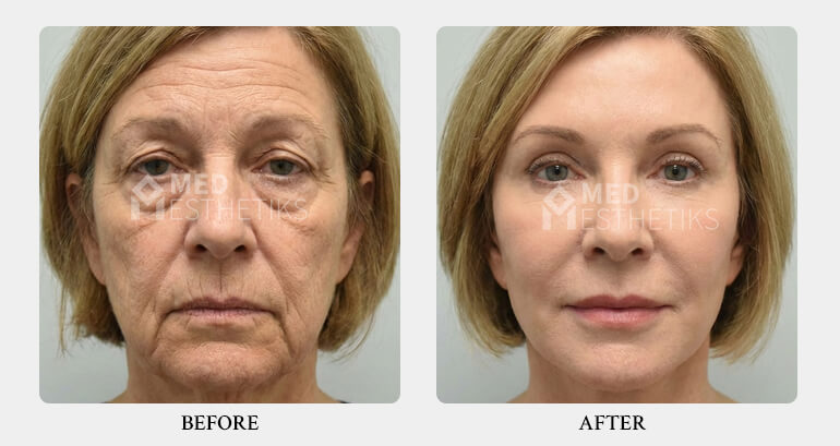 facelift surgery before after 01