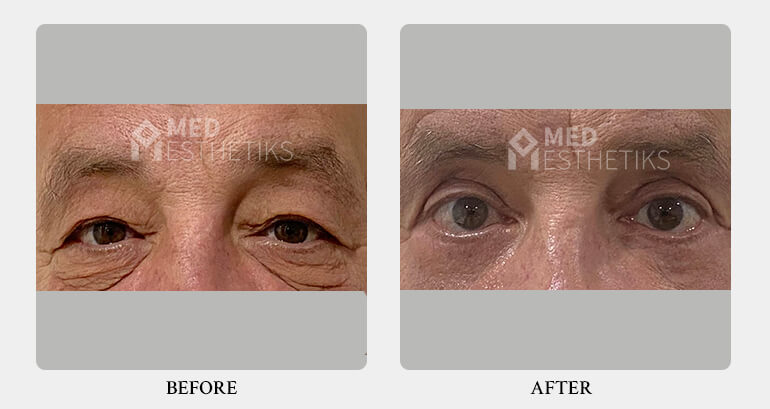 Blepharoplasty before after - Dr Lokesh Handa -Med Esthetiks -01 Blepharoplasty before after - Dr Lokesh Handa -Med Esthetiks -01