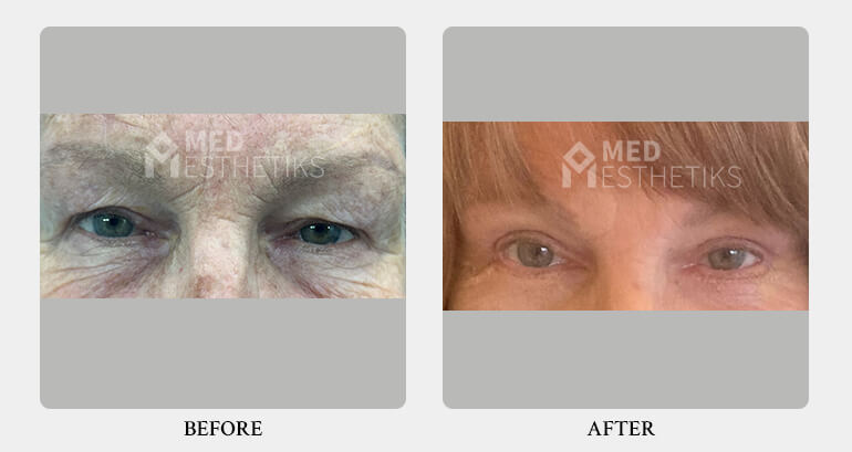 Blepharoplasty before after - Dr Lokesh Handa -Med Esthetiks -023 Blepharoplasty before after - Dr Lokesh Handa -Med Esthetiks -023