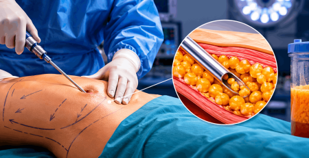 how much fat can be removed with lipo