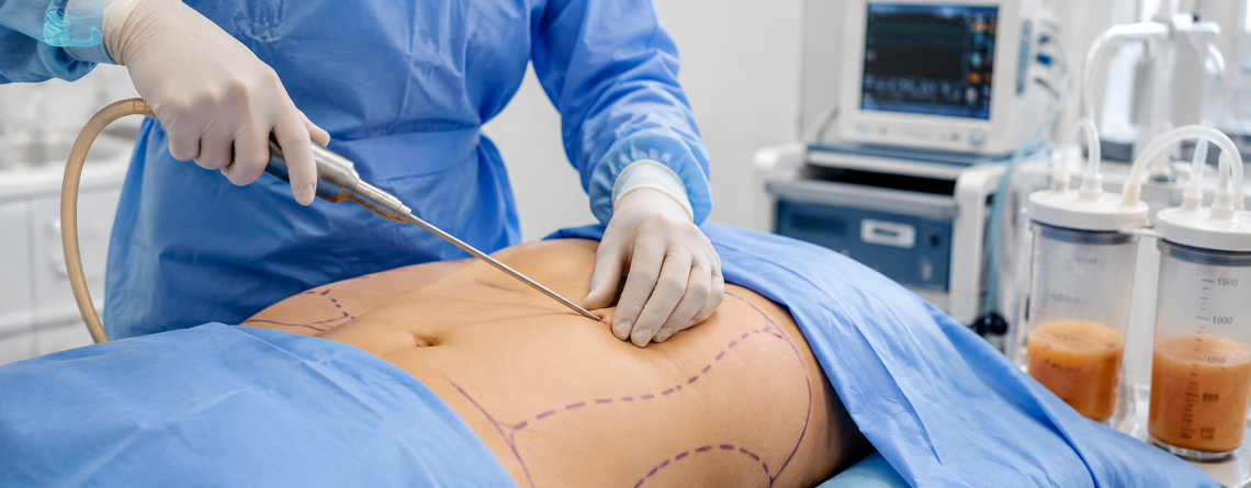 how to Choose Liposuction Clinic in Delhi