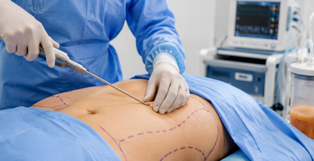 how to Choose Liposuction Clinic in Delhi