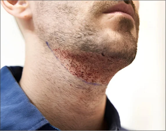 Med Esthetiks_Beard Transplant in Delhi_15