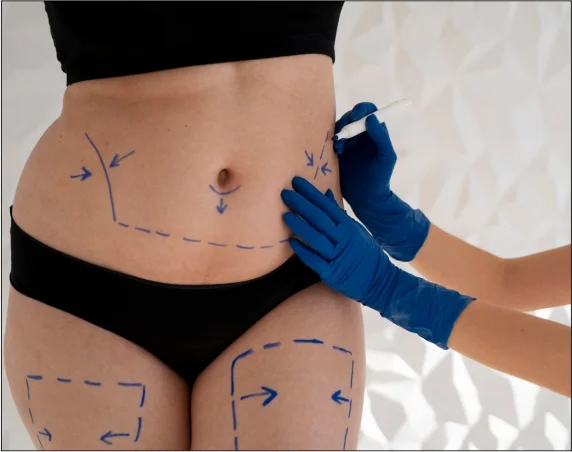 Med Esthetiks_Body Lift in Delhi_12