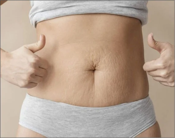 Med Esthetiks_Mommy Makeover Procedure and Recovery Timeline_19